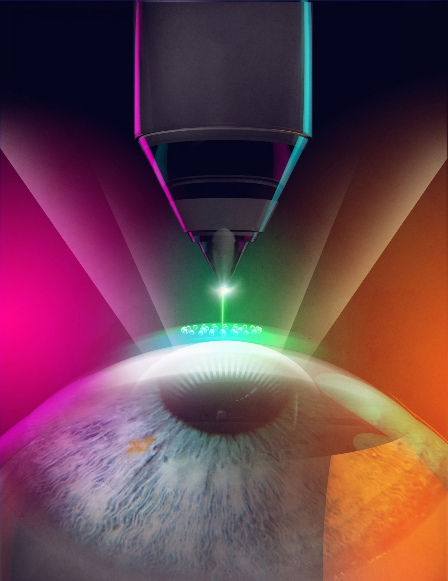 femtosecond laser treatment of the eye